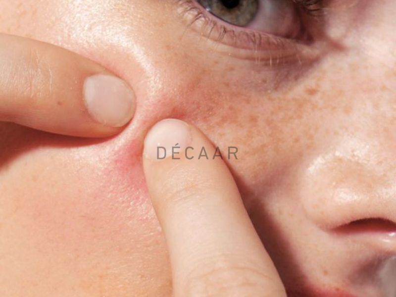 peel da lên mụn đầu trắng